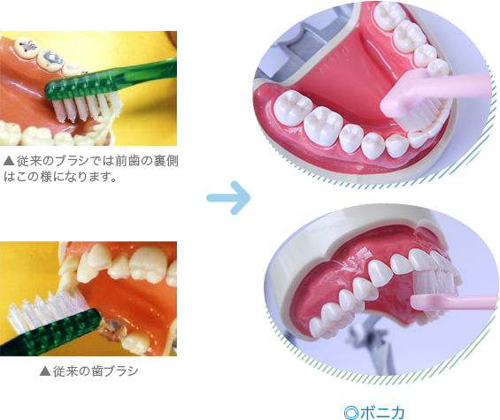 前歯 裏側の磨き方